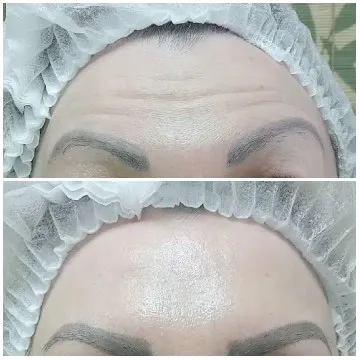 Forehead Before and After Treatment