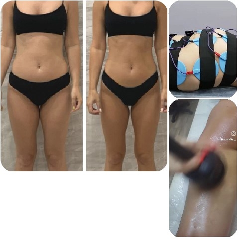Body Contouring Treatment Before and After