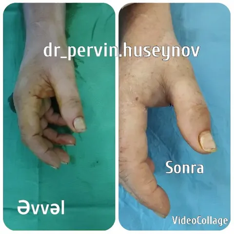 Hand Before and After Procedure