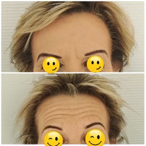 Before and After Forehead Comparison
