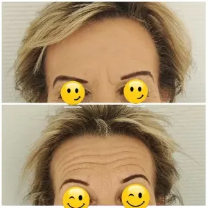 Before and After Forehead Comparison