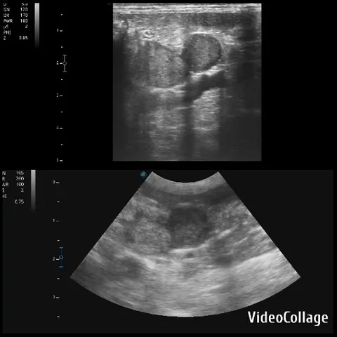Two Sonogram Scans Side by Side