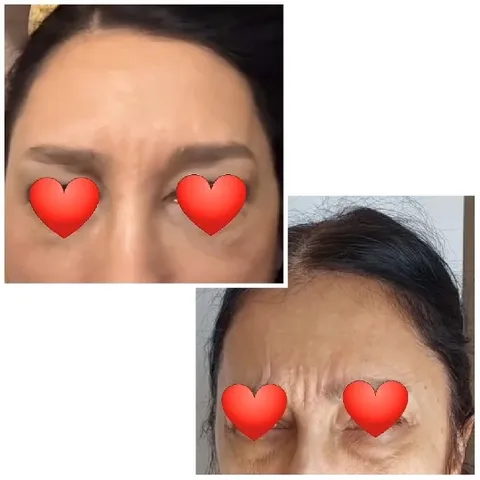 Before and After Forehead Shots