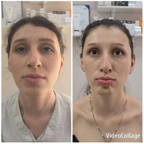 Before and After Cosmetic Treatment