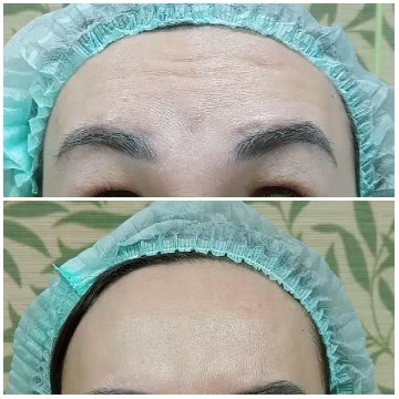 Before and After Forehead Comparison