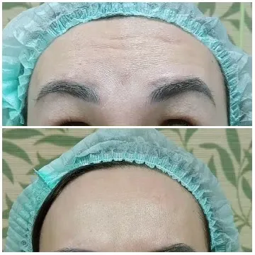 Before and After Forehead Comparison