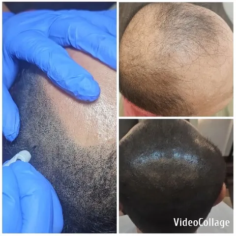 Scalp Treatment Process Progression