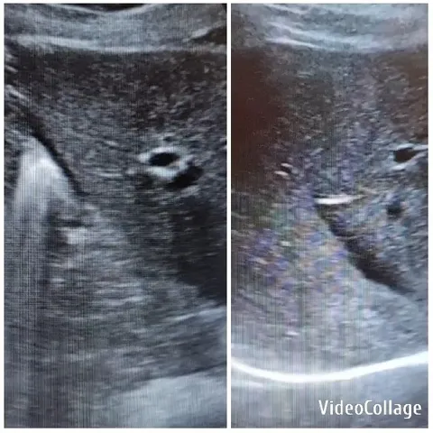 Two Ultrasound Scans of Internal Structures