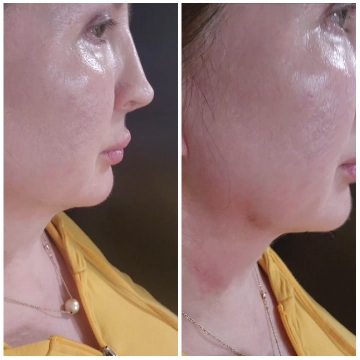 Before And After Skincare Comparison
