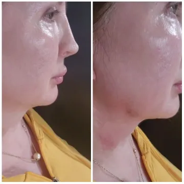 Before And After Skincare Comparison