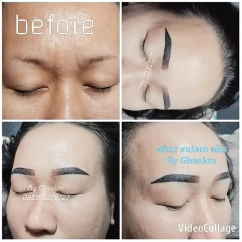 Before-and-After Cosmetic Procedure
