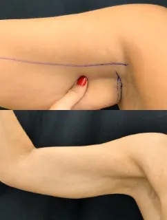 Before and After Arm Comparison