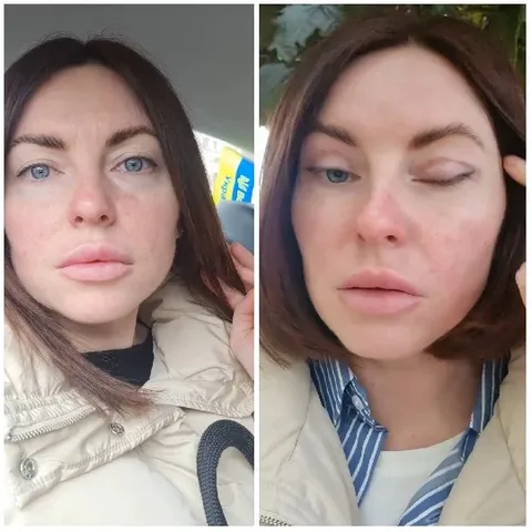Woman with Swollen Left Eye