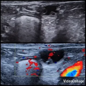 Ultrasound Scans with Blood Flow Mapping