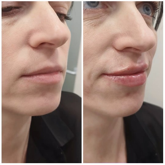 Face Comparison with Enhanced Lips