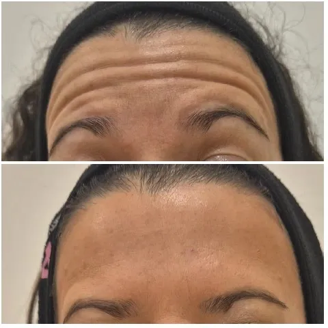 Forehead Before and After Treatment