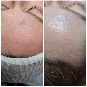 Forehead Before and After Treatment