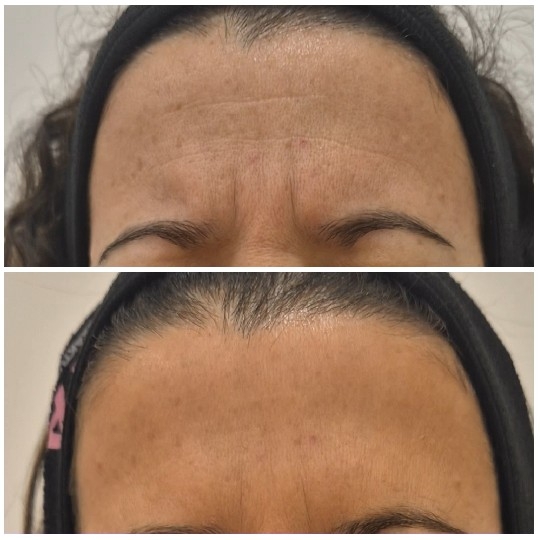 Before and After Skincare Comparison