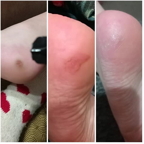 Foot Health Comparison