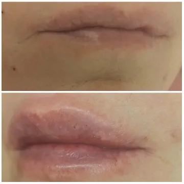Before and After Lip Comparison