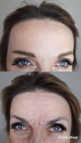 Close-Up of Forehead and Eyes