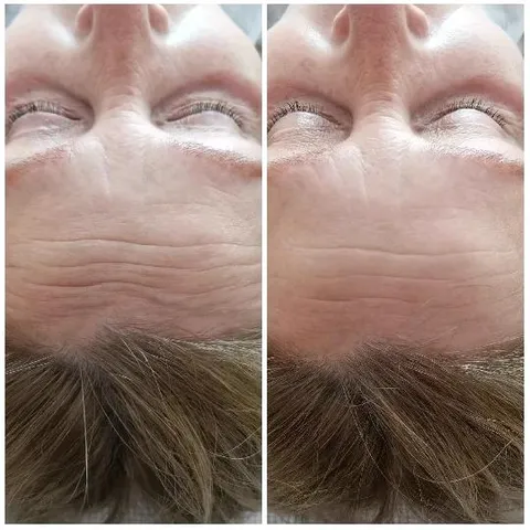 Forehead with Wrinkles Comparison