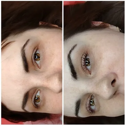 Before and After Eye Treatment