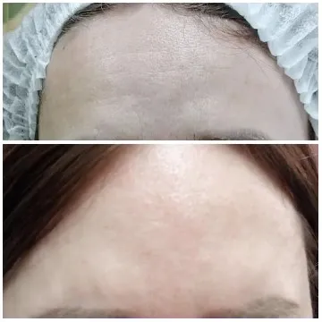 Forehead Transformation Before and After