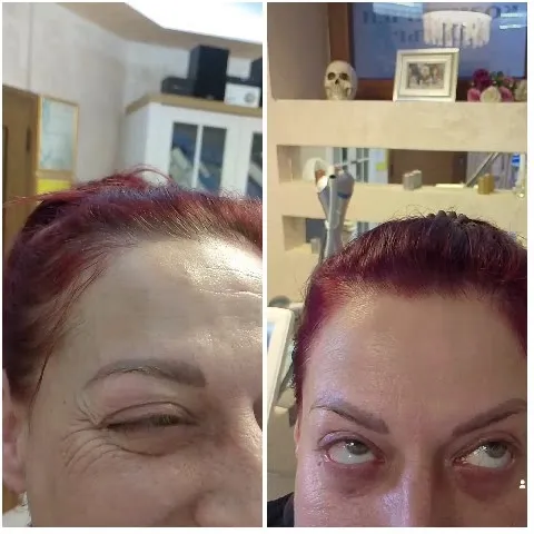 Eyebrow Treatment Before and After