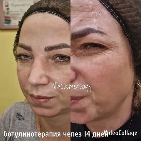 Before and After Facial Treatment