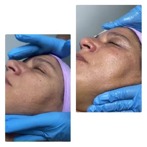 Facial Treatment with Blue Gloves