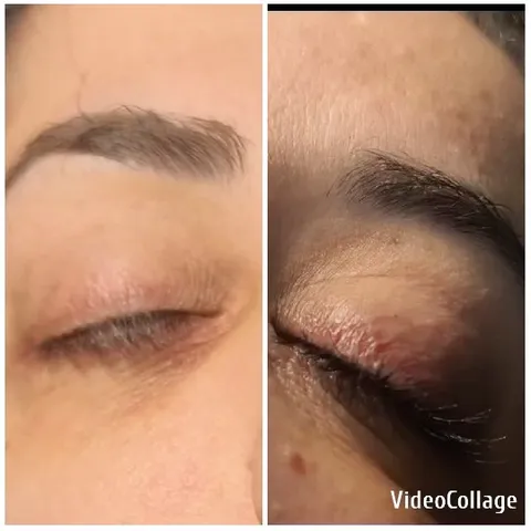 Eye Treatment Before and After