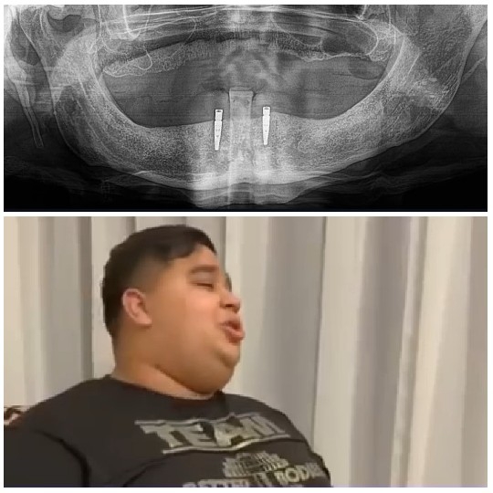 Dental X-Ray and Man Reacting