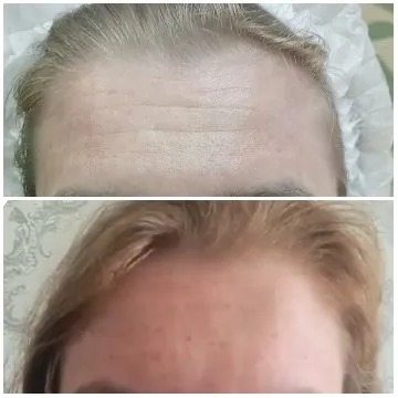 Skincare Treatment Before and After