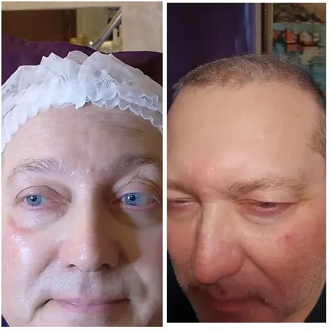 Hair Cap Before and After