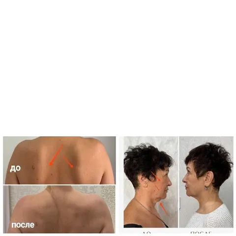 Before and After Body Comparison