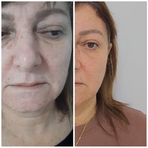 Before and After Aesthetic Treatment