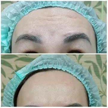 Before and After Forehead Comparison