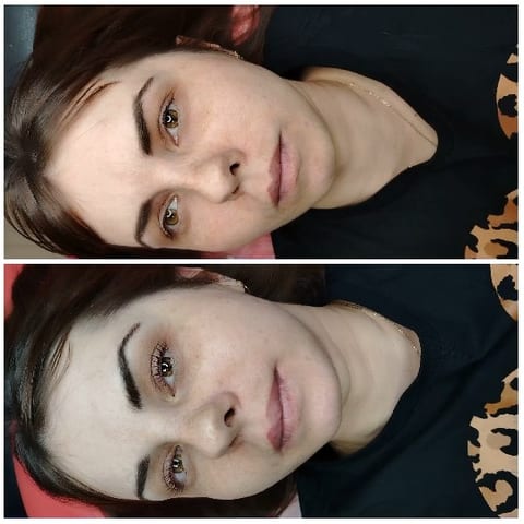 Before and After Cosmetic Procedure