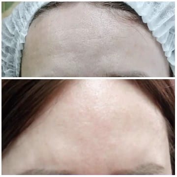 Forehead Transformation Before and After
