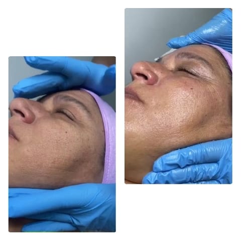 Facial Treatment with Blue Gloves