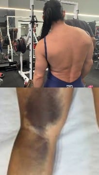 Person in Gym and Bruised Arm