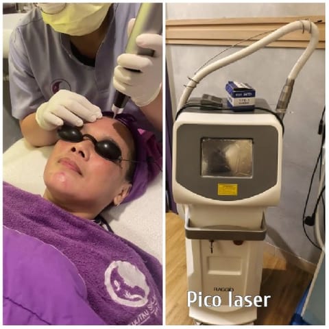 Facial Treatment with Pico Laser
