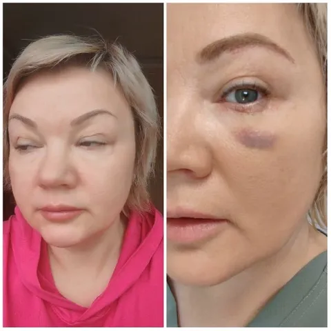 Woman's Face with Bruise