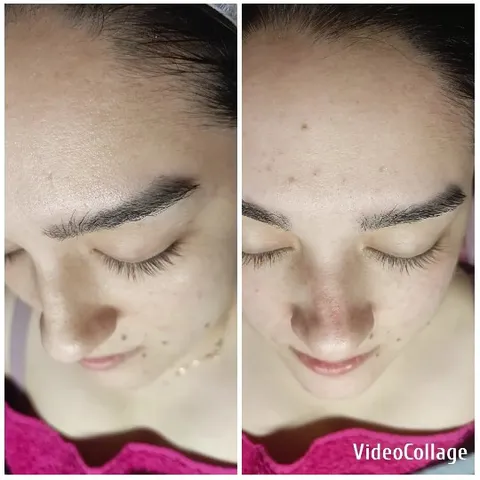 Skincare Treatment Before and After