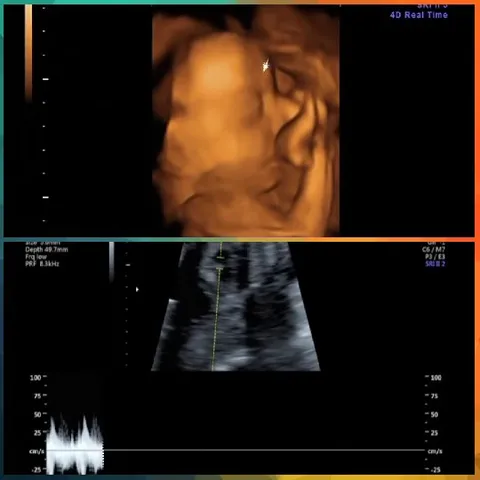 Medical Imaging of Ultrasound Scans