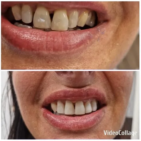 Before and After Dental Improvement