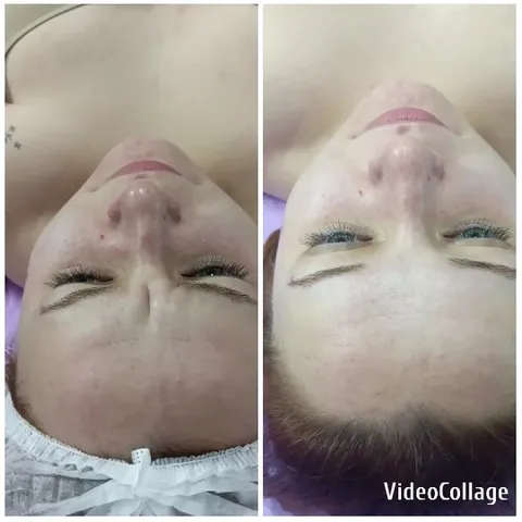 Before-and-After Skincare Comparison