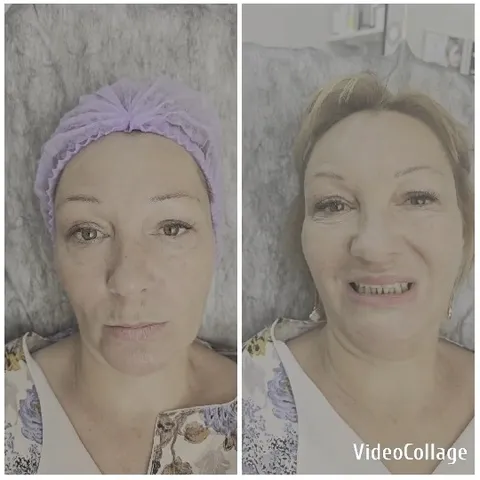 Dental Procedure Before and After