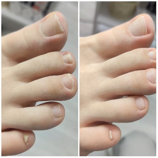 Toes Before and After Nail Care